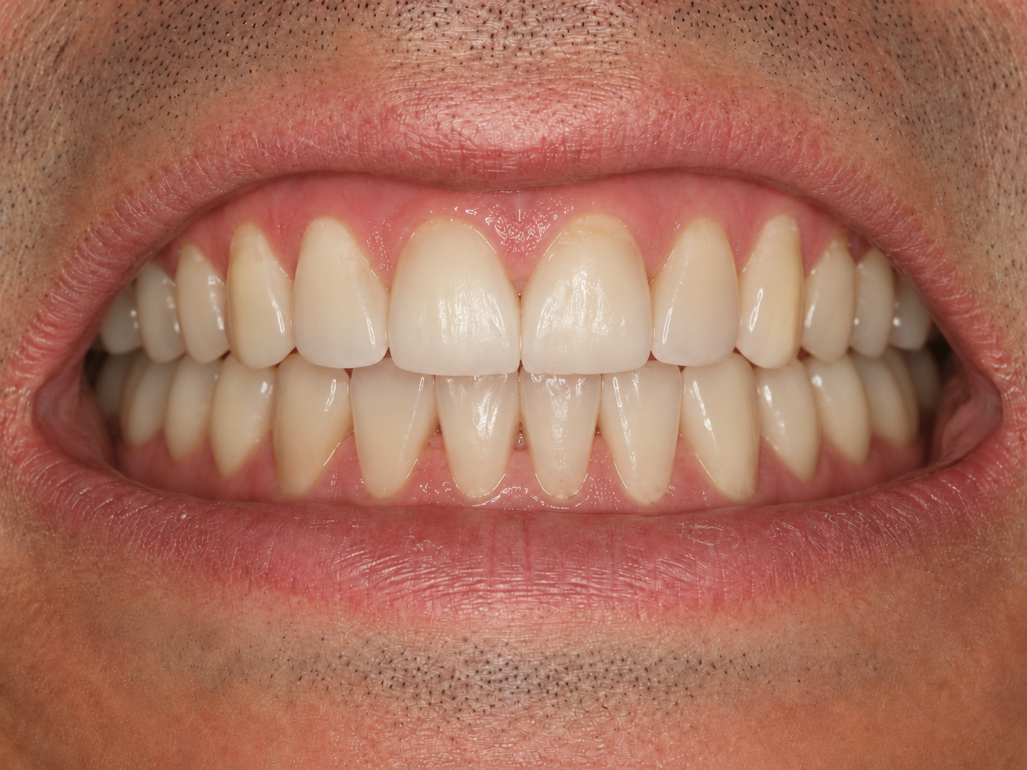 Rezultatul dentar după tratament, cazul 02