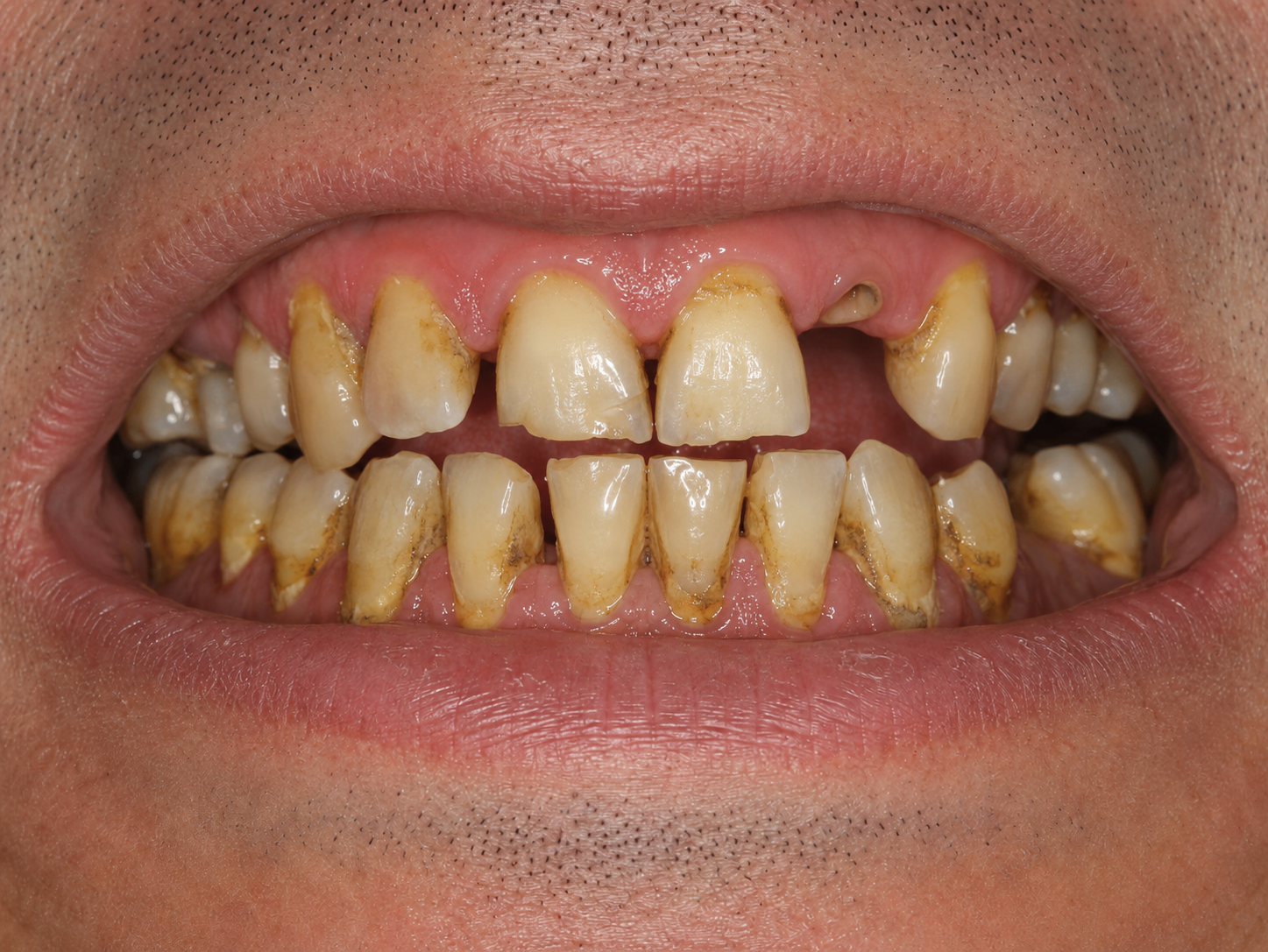 Situația dentară înainte de tratament, cazul 02